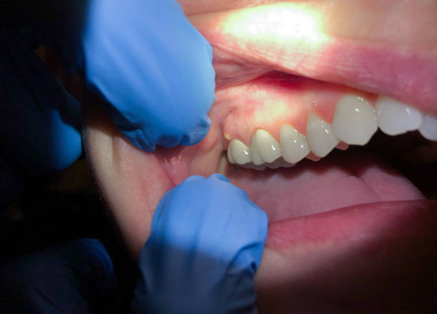 Best Emergency Wisdom Tooth Extraction in Hayfield, MN